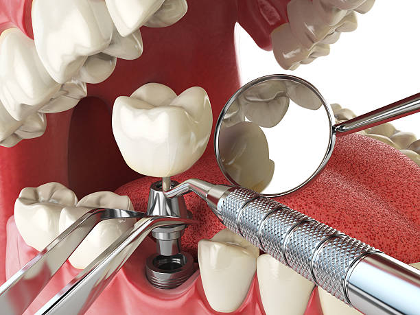 Best Emergency Tooth Extraction in Unionville, TN